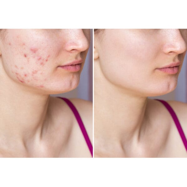 Dr. Belmeur Spot Care Ampoule 22ml – beruhigendes Serum mit Panthenol, Beta-Glucan, Chaga-Pilz und Teebaumöl gegen Unreinheiten und Rötungen. Abbildung vorher / nachher Bild.